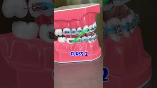 COMMON WAYS TO WEAR RUBBER BANDS WITH BRACES 🦷 ORTHODONTIST EXPLAINS