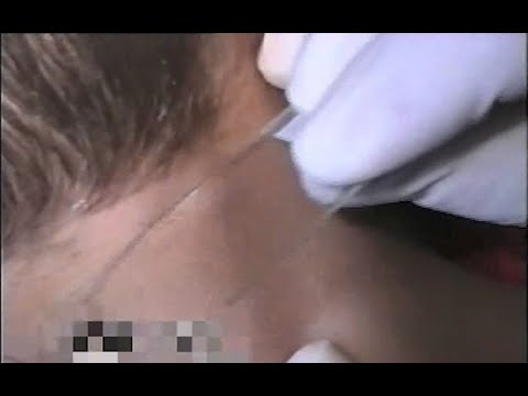 Varicella Zoster Virus: Procedures for Collecting Varicella Skin Lesions and Blood Specimens