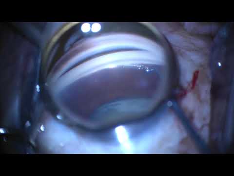 Hydrus Microstent Implantation