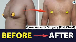 Gynecomastia Surgery Before After Results After 10 Days | Gynecomastia Surgery Before After Results