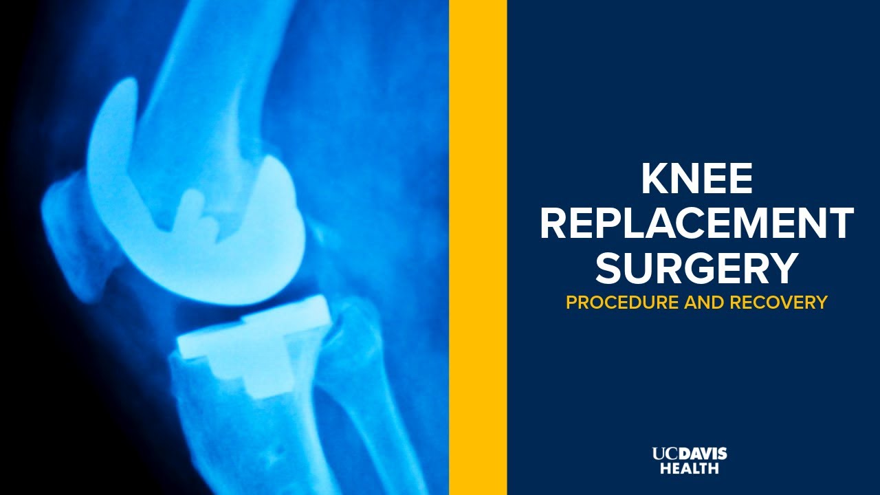 Thumbnail preview of Knee Replacement Surgery Explained | UC Davis Health