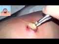[ WARNING ] Biggest abscess Pop | one liter puss drained @locus.11m77 #abscess #satisfyingvideo