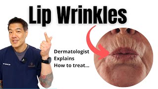 Why Do Women Get Upper Lip lines | Dermatologist explains Causes & Solutions