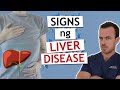 Senyales na Nasisira ang Liver or Atay (sakit sa Atay)