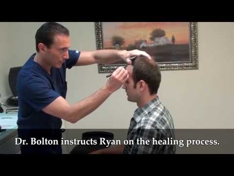 Ryan Hair Transplant Timeline Video