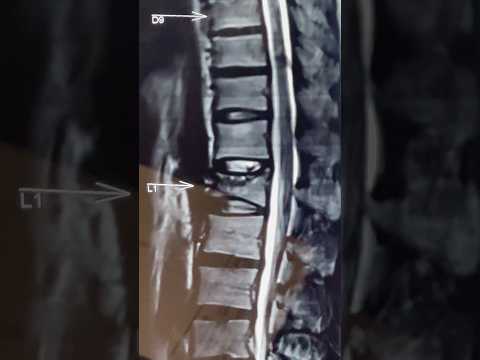 MRI spine fracture-How to read it - Dr. Ajay Kothari