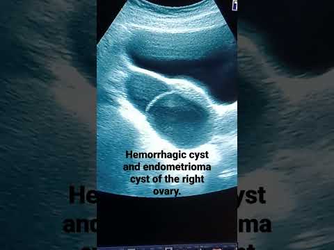 Ovarian Hemorrhagic cyst and endometrioma cyst in patient with irregular bleeding/period .