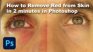 How to Remove Red from Skin in Photoshop in less than 2 minutes!