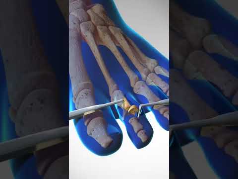 Can't Touch this Surgery: Fixing Hammer Toe