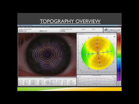 [Online Seminar] M. Korenfeld: Use the Keratograph® 5M to Support Your Premium IOL Charges