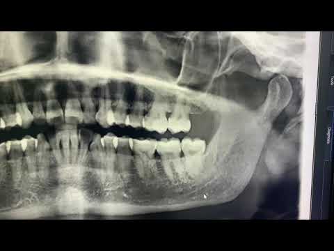 Wisdom Tooth Extraction