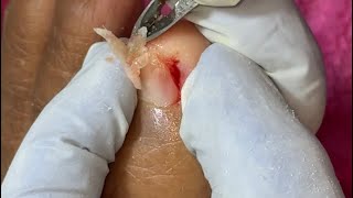 Ep_8837 Foot nails skin removal 👣 หนังแข็ง..เกิดขึ้นได้ยังไงคะ 😅 (clip from Thailand)