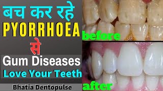 Symptoms Of Pyorrhea Gum Disease | Pyorrhoea Bleeding Gums Treatment | पायरिया का ईलाज