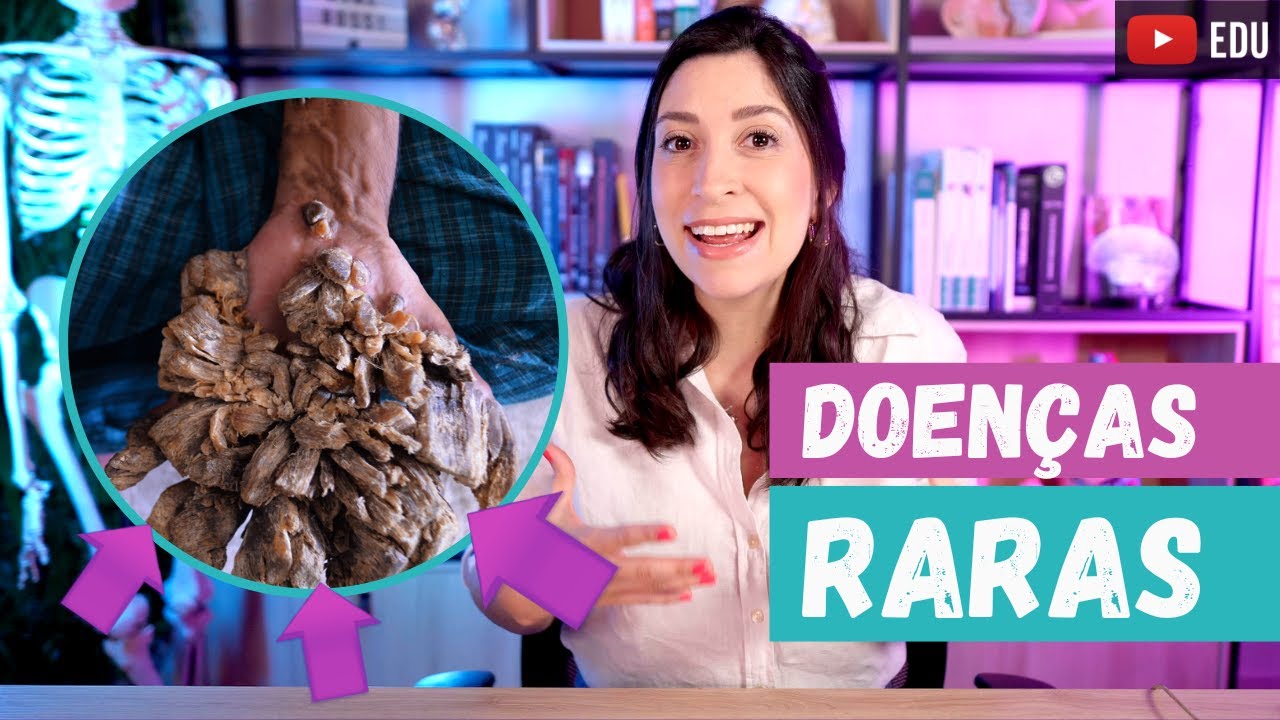 3 DOENÇAS RARAS que acometem seres humanos !