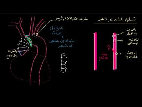 الصفوف المتقدمة الأحياء أمراض الجهاز الدوري علاج تسلّخ الشريان الأبهر