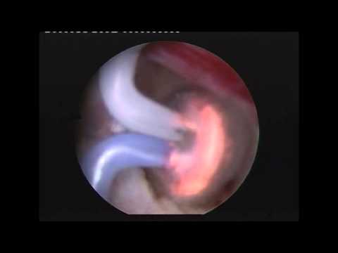 Prostata-Massage und Oralsex Prostatitis Symptome und Verlauf