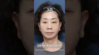 목 리프트 성형 시술