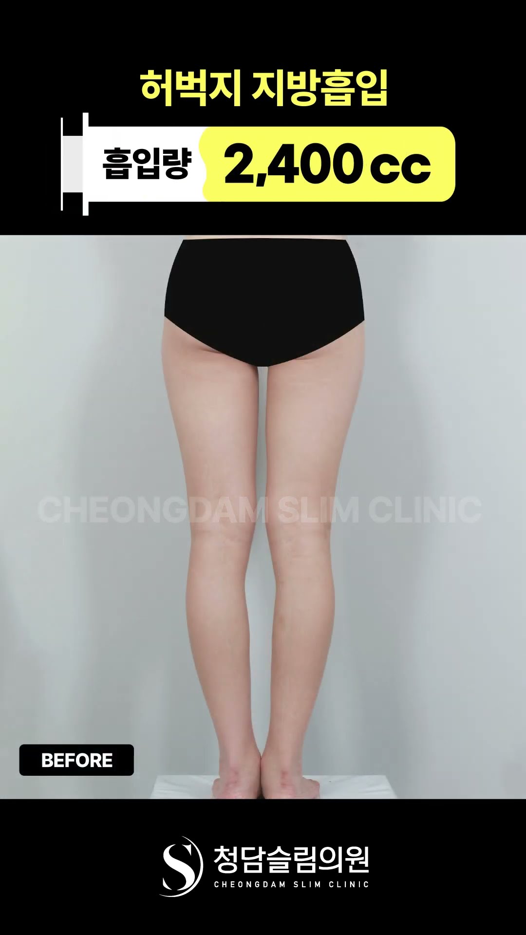 승마살 정리 후, 더 매끈해진 다리 라인✨