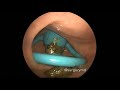 Rectal Vibrator