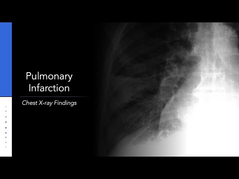 Pulmonary Infarction: Chest X-ray (Hampton's Hump)
