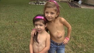 Miracle Girls Born With Hearts Beating Outside Chest Meet For First Time