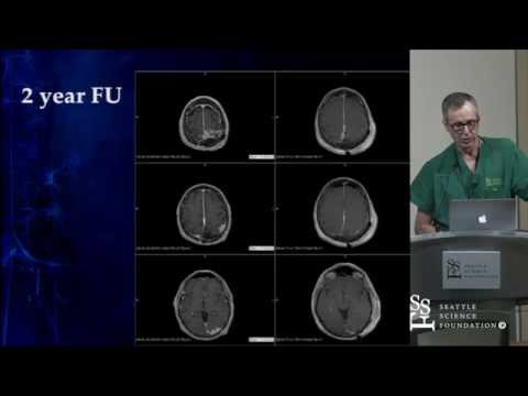 Behandlung duraler arteriovenöser Fisteln durch Cameron McDougall, M.D.