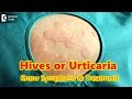 Hives | Urticaria-Causes,Symptoms,Treatment | Skin Rash | Allergy - Dr.Rasya Dixit | Doctors' Circle