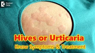 Hives | Urticaria-Causes,Symptoms,Treatment | Skin Rash | Allergy - Dr.Rasya Dixit | Doctors&#39; Circle