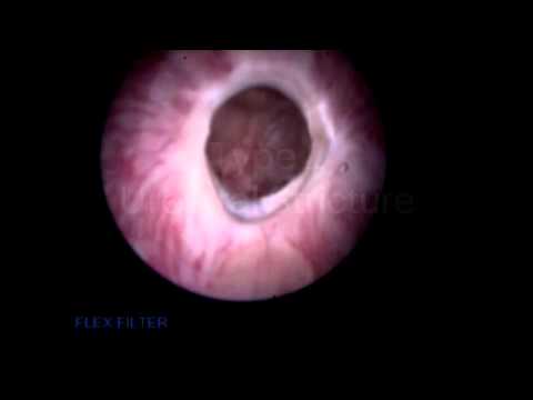 New Staging System For Anterior Urethral Strictures