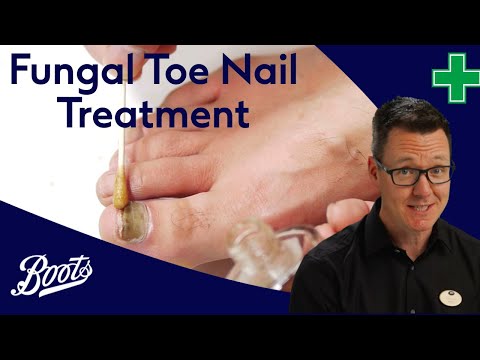 How to treat fungal toenail infections | Meet Our Pharmacy Team | Boots UK