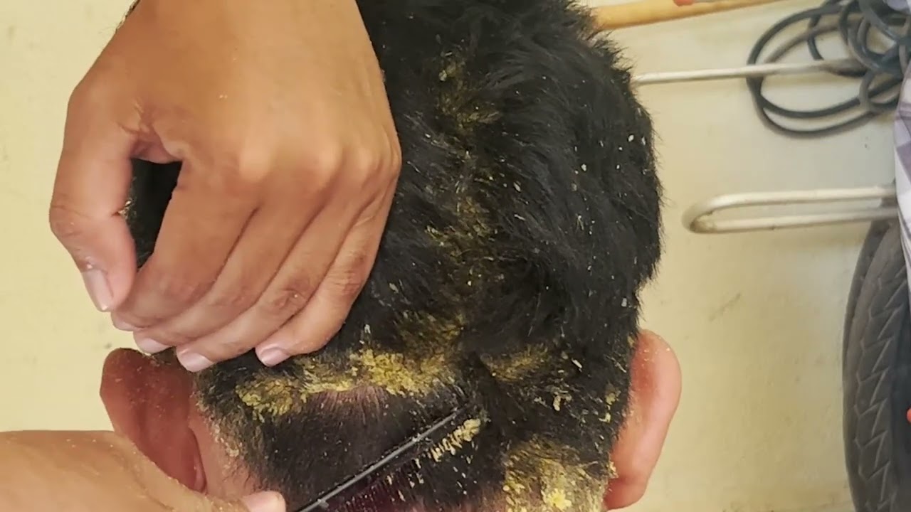 Amazing Big Flake In My Mother Hair !!  Many Dandruff Scratching Scalp 2 1