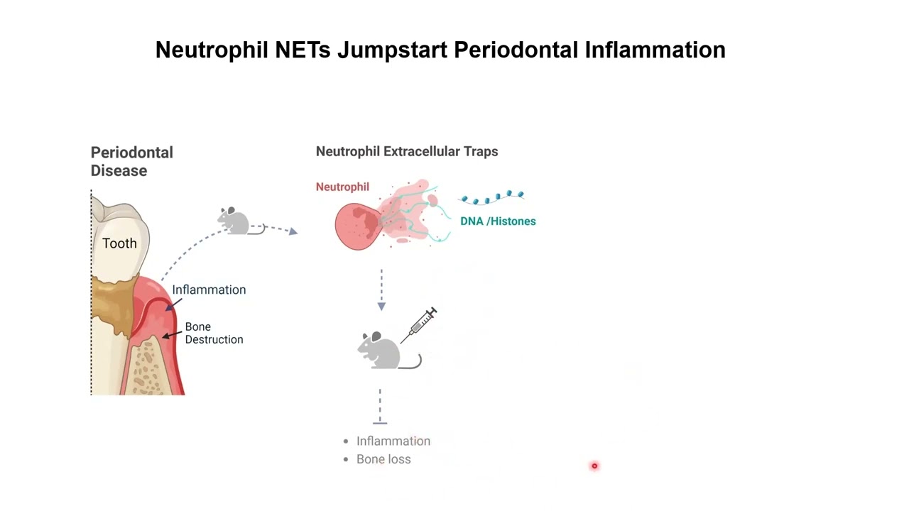 Neutrophil extracellular traps jumpstart periodontal inflammation