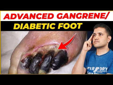 Limb Blackening and Gangrene in Diabetes: Causes & Advanced Treatments by Dr. Gaurav Gangwani
