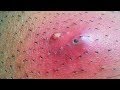 Ingrown Hair 2019 - Best Ingrown Hair Ever