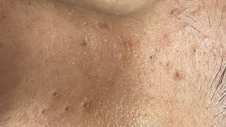 Removes blackheads completely 🥰