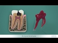 Endodontic treatments