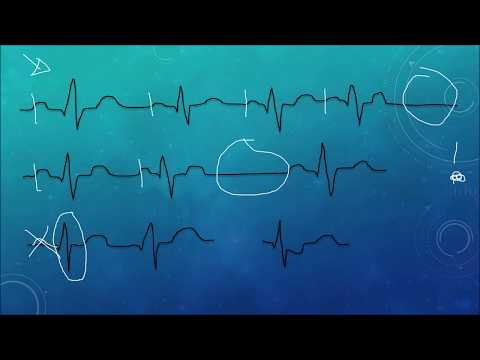 EKG Crashkurs, Teil 2: Sinusrhythmus, AV-Block, SA-Block