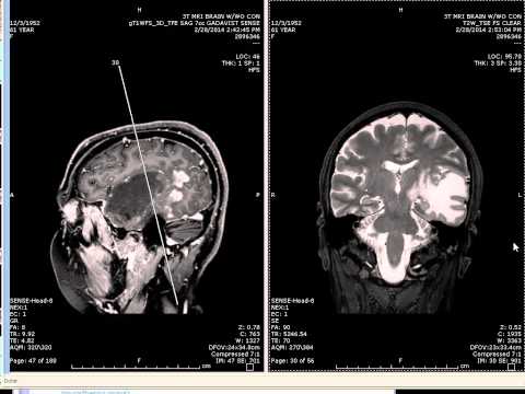 Brain Tumor - Meningioma - Homonymous Hemianopsia - Head MRI