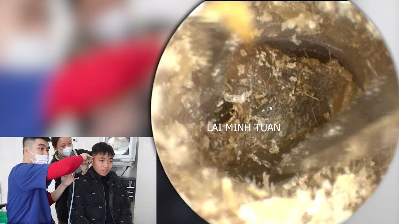 💤 耳かき | 耳掃除 | 大きくて硬い耳垢。| DR. LAI MINH TUAN