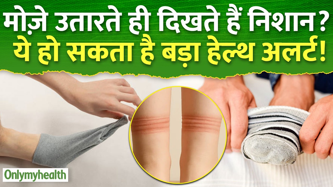 मोज़े उतारते ही दिखते हैं निशान? ये हो सकता है बड़ा हेल्थ अलर्ट | OnlyMyHealth