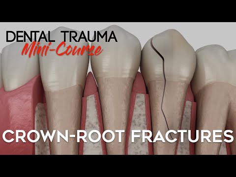 Dental Trauma Mini-Course - Part 5 - Dental Trauma Guide - Crown-Root Fractures