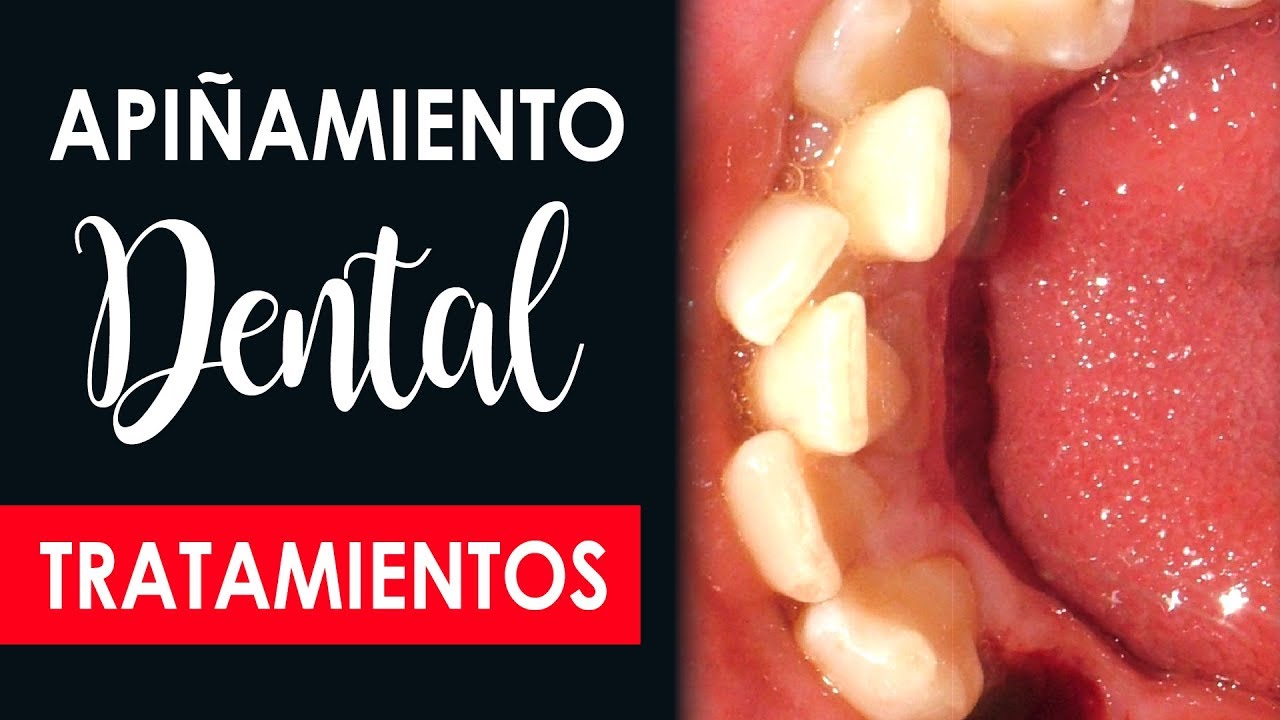 APIÑAMIENTO DENTAL TRATAMIENTOS | ¿Tienes Dientes apiñados