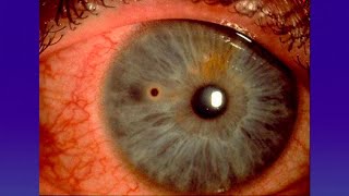 ¿Qué hacer ante una emergencia ocular