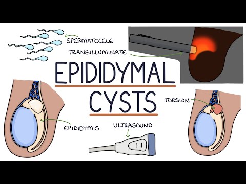 Understanding Epididymal Cysts