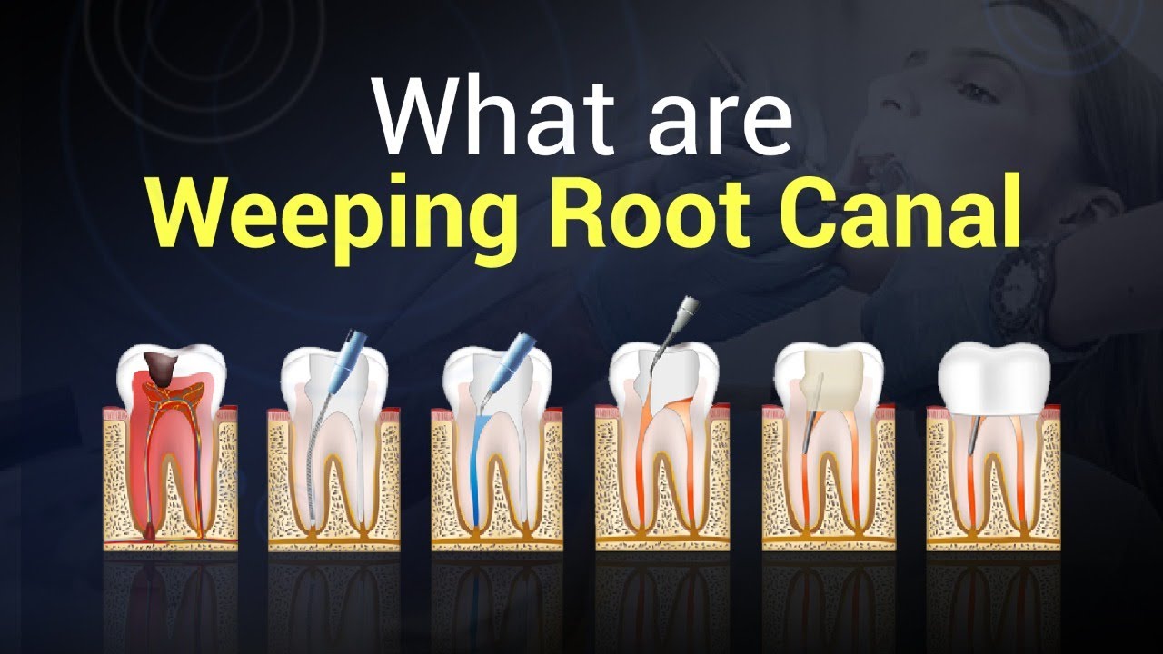What is weeping canal in endodontics? Archive EN