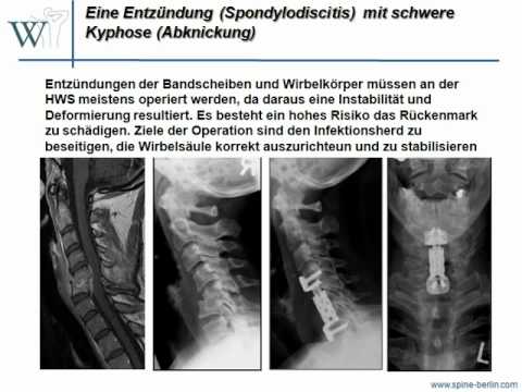 Vorschriften nach Operationen an Bandscheibenbruch Analgesie nach Kniegelenkersatz