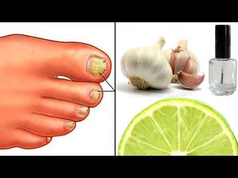 Atrofichesky el hongo de las uñas El hongo de las uñas el tratamiento el cuerno curvo