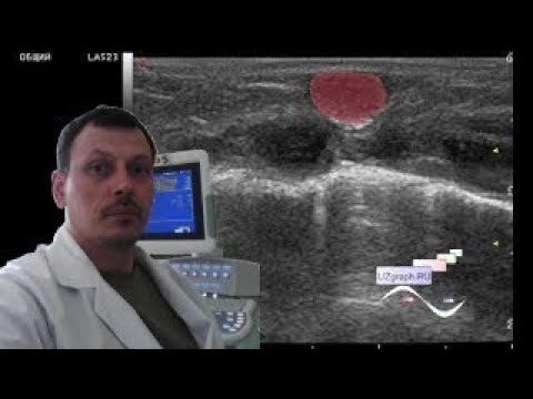 Pediatric Soft tissue ultrasound - Chest wall lesion