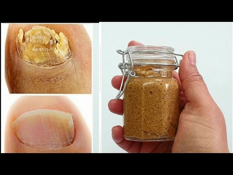 Eliminarea ciupercii unghiilor de la picioare