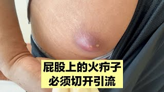 屁股上的火疖子，已经化脓了，只能切开引流，伤口敞开不缝合！#胃肠道 #癌症 #科普 #养生
